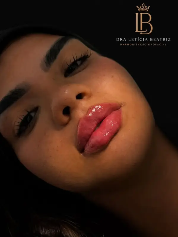 Preenchimento Labial